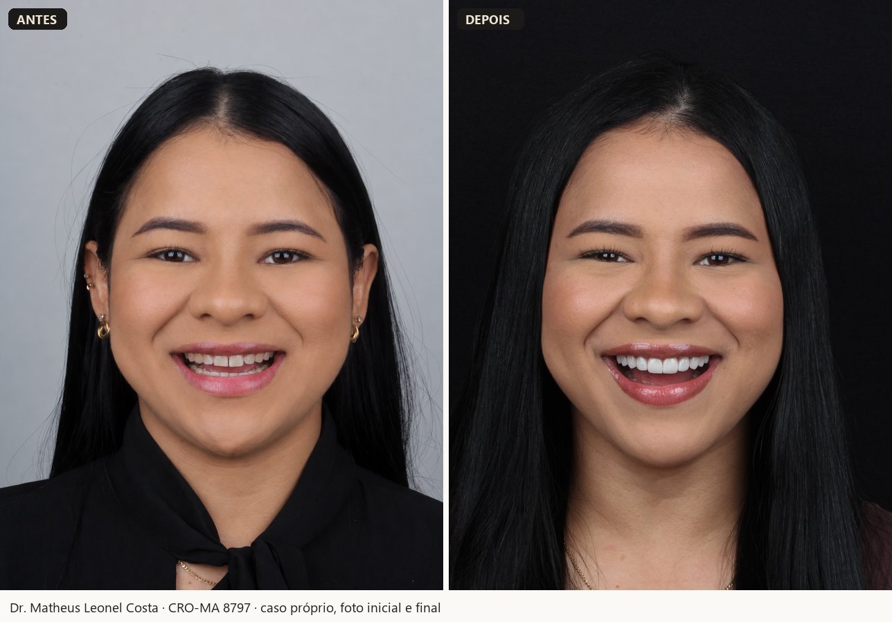 Antes e depois de facetas em resina, caso 01