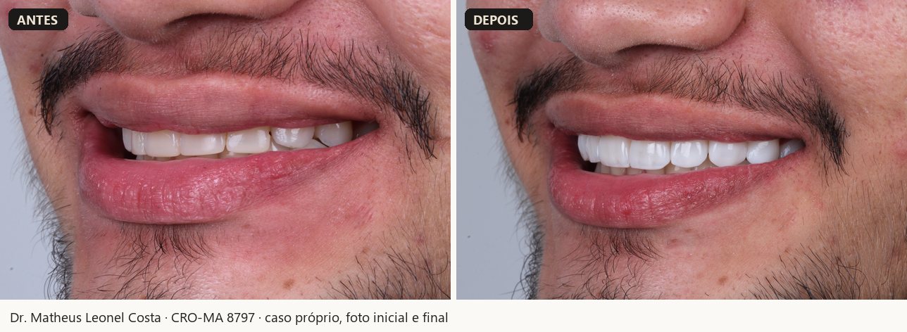 Antes e depois de facetas em resina, caso 03