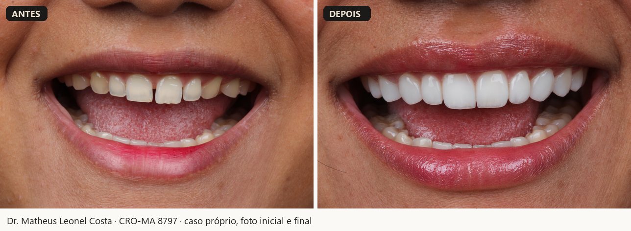 Antes e depois de facetas em resina, caso 04