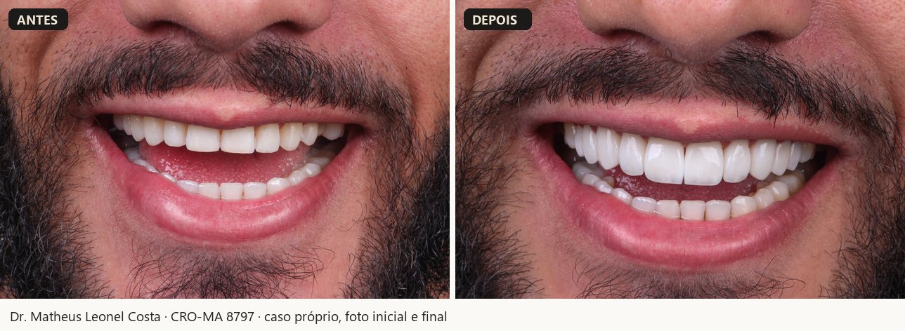 Antes e depois de facetas em resina, caso 05